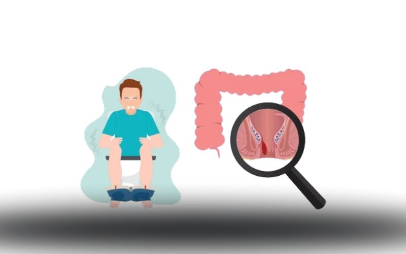 بیماری بواسیر چیست؟