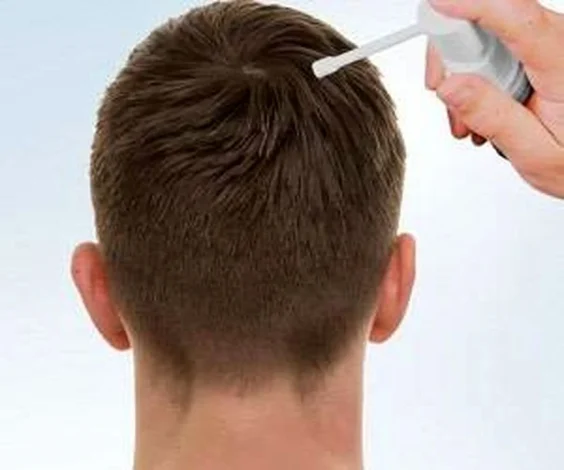 Leer ken die metodes om haarverlies by mans te behandel