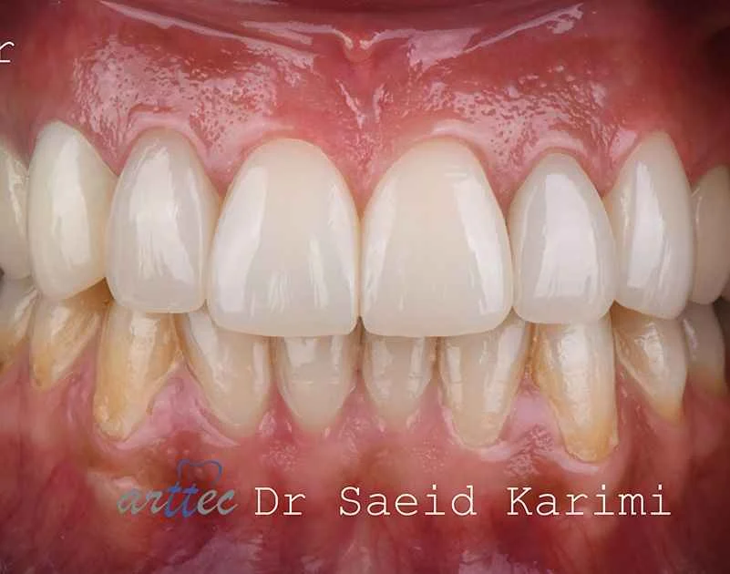 How can dental laminates end insomnia problems