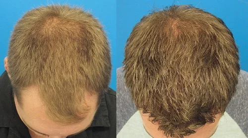 Minoxidil Benefits, side effects, method of use